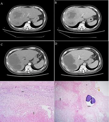 Case report: Conversion therapy to permit resection of initially unresectable hepatocellular carcinoma